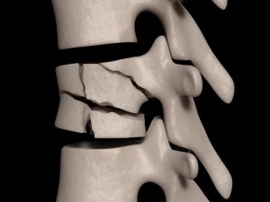 spinal-fracture-300x225